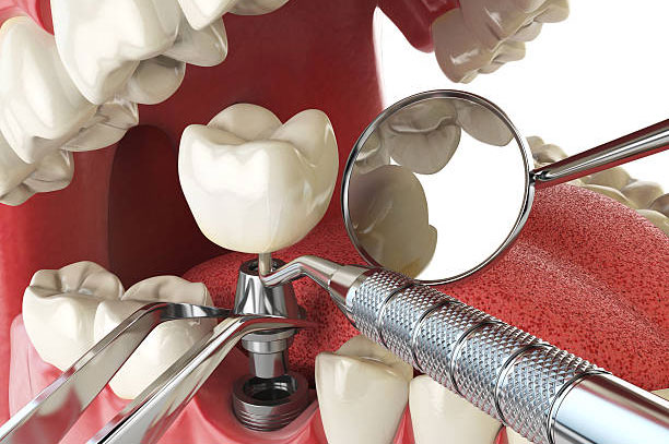 Dental Implants