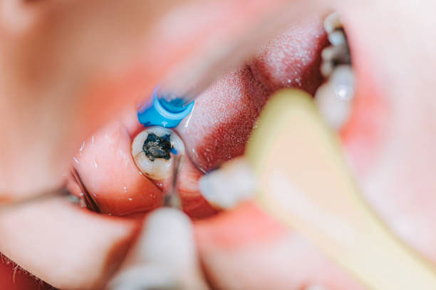 Root Canal Treatment