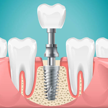 Dental Implants in Vijayawada