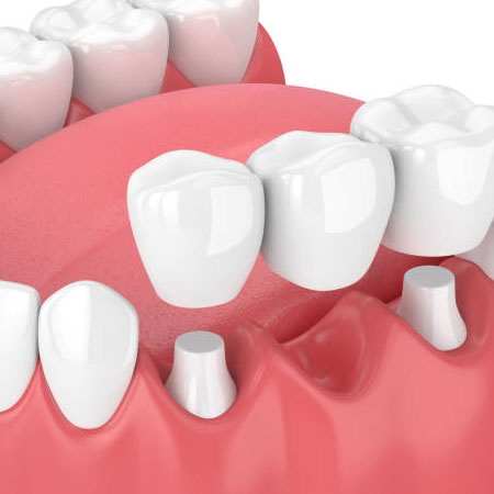 Dental crowns & bridges Treatment in Vijayawada