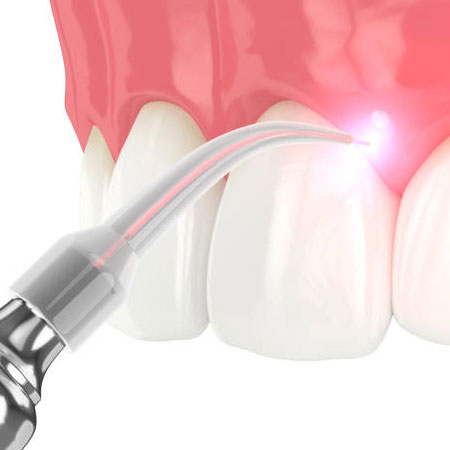 Laser Dentistry in Vijayawada