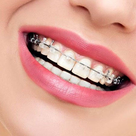 Orthodontics Treatment in Vijayawada