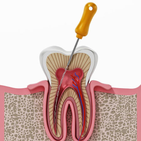 Root Canal Treatment in Vijayawada