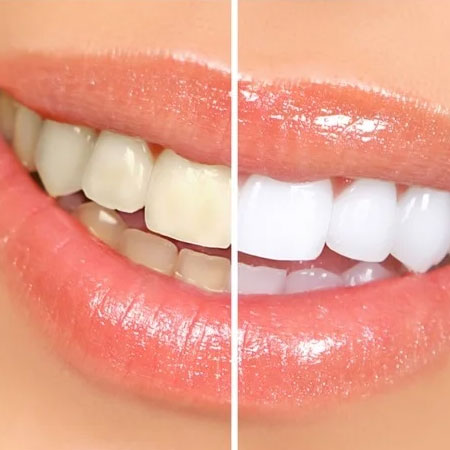 Tooth Whitening hospital in Vijayawada